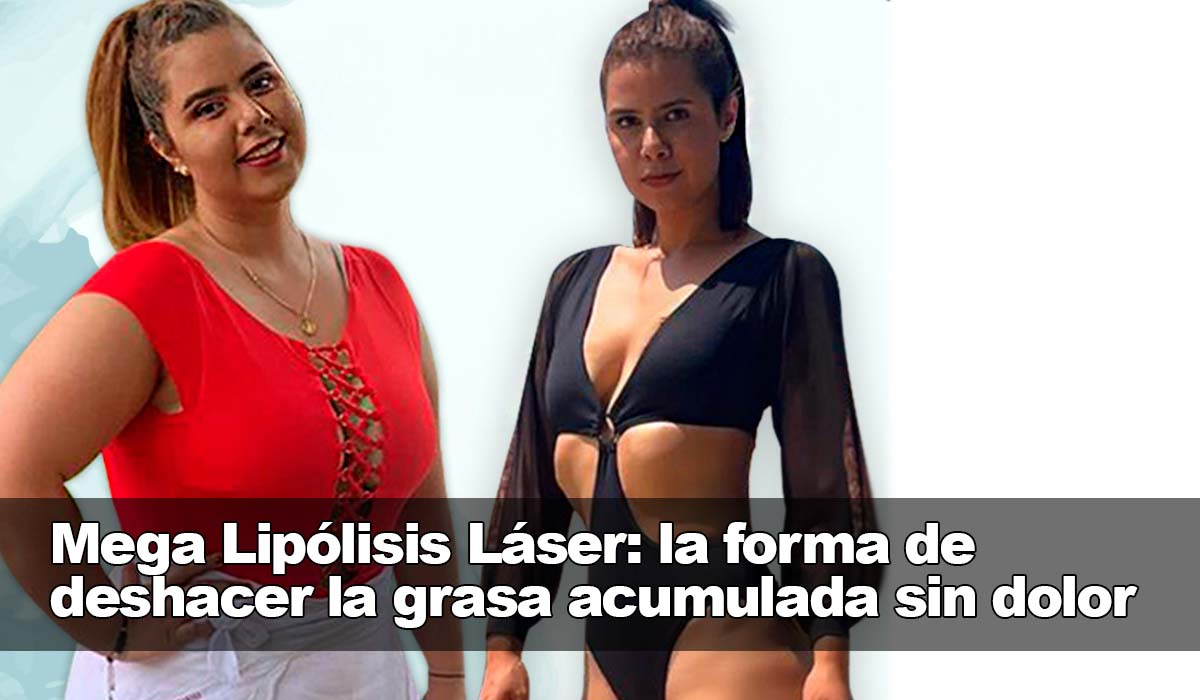 La Mega Lipólisis Láser: la manera eficaz de eliminar la grasa sin problemas